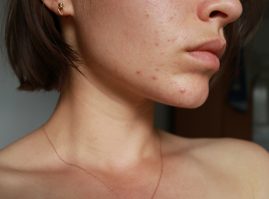 Teen Acne, Hormones and Gut Health