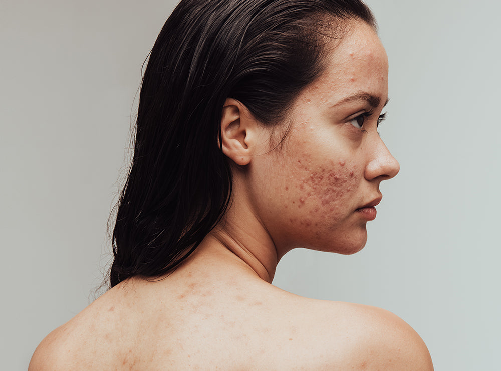 5 Common Myths About Acne